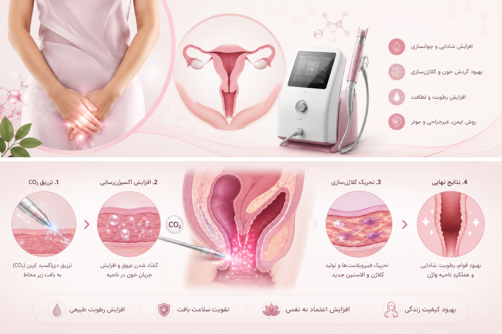 کربوکسی تراپی واژن